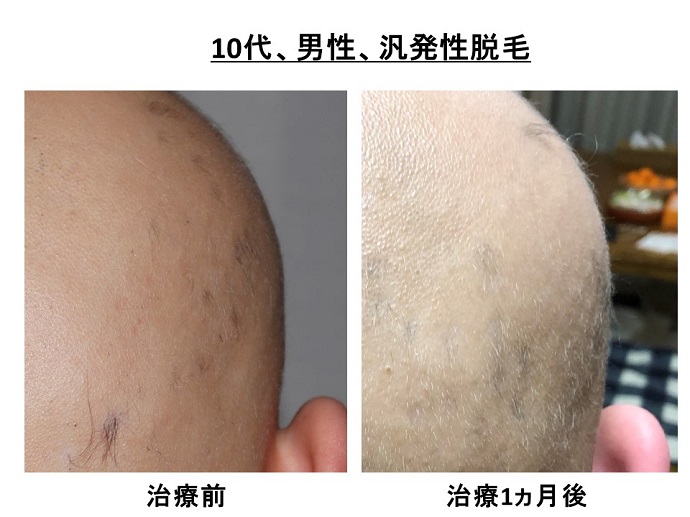 円形脱毛症　病院